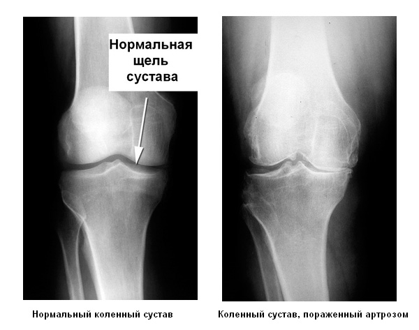 Рентгенограмма остеоартроза
