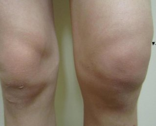 Что может случиться после травмы колена