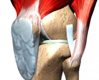 Лигаментит и лигаментоз связок коленного сустава