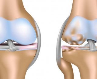 Восстановление хрящевой ткани колена