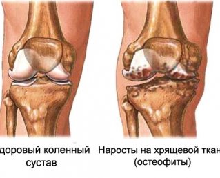 Остеофиты коленного сустава: причины, симптомы, методы диагностики и лечения