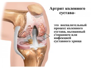 Артрит коленного сустава