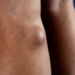 Киста Бейкера коленного сустава: причини, симптоми, размери, фото