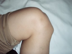 Болезнь Осгуда-Шлаттера коленного сустава: группа риска, симптоми и лечение