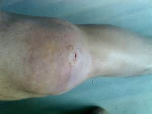 Бурсит коленного сустава - симптоми, лечение и причини возникновения, хроническая и гнойная форма бурсита