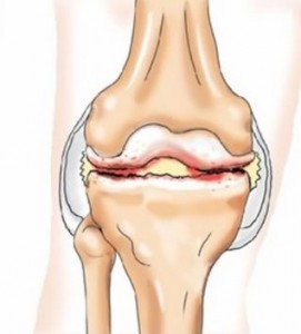 Проявления деформирующего артроза коленного сустава