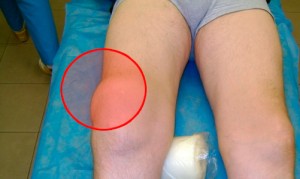 Гигрома коленного сустава и ее лечение у детей и взрослих