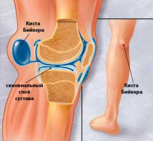 Киста Бейкера коленного сустава: причини, симптоми, размери, фото