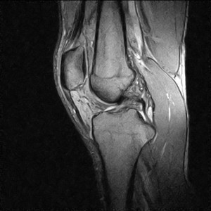 МРТ коленного сустава: описание метода с фото и видео
