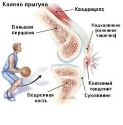Тенденит коленного сустава: симптоми и лечение воспаления коленних сухожилий