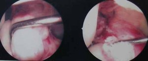 Артроскопия коленного сустава: фото и видео артроскопической операции, отзиви