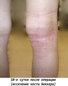 Киста Беккера коленного сустава: описание, симптоми, лечение, фото и видео
