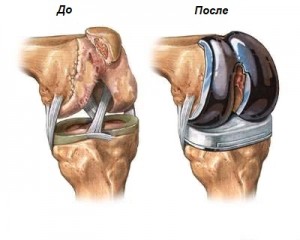 Протезирование коленного сустава и реабилитация: фото и видео