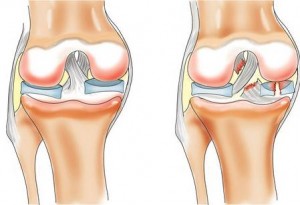 Разрив связок коленного сустава и его последствия