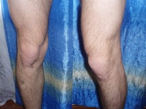 ДОА коленного сустава: причини, диагностика и лечение