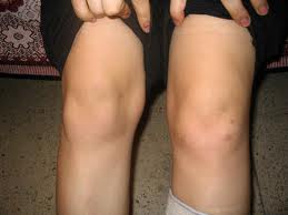Опухоль колена при воспалении мениска
