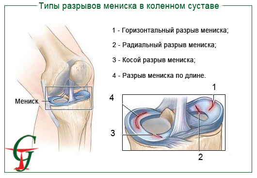 Утолщение ногтя на большом пальце ноги лечение