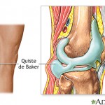Киста Беккера коленного сустава: описание, симптоми, лечение, фото и видео