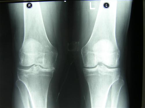 Остеоартроз коленного сустава: стадии и лечение