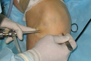 Артроскопия коленного сустава: какой наркоз лучше?