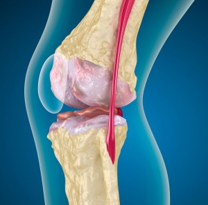 Пателлофеморальный артроз колена
