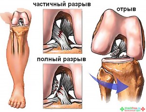 Разрив крестообразной связки коленного сустава