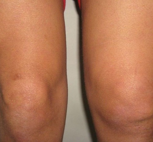 Опухоль коленного сустава и как ее лечить