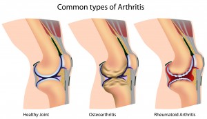 Признаки артрита коленного сустава