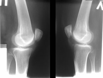 Болезнь Кенига коленного сустава - симптоми и лечение для детей и взрослих
