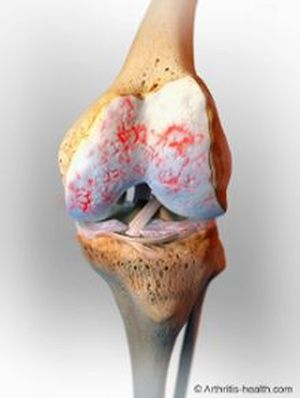 Боль в колене - почему возникают боли в области или внутри коленки