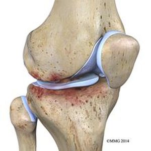 Боль в коленях при приседании и вставании - почему болят коленние сустави после резких движений