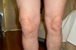 Синовит коленного сустава - умеренний и острий, гнойний и геморрагический, хронический и инфекционний