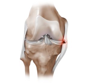 Острая боль в колене - отчего она возникает, внезапная и пульсирующая боль в коленном суставе
