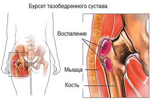 Сумки бедренного сустава Сумки бедренного сустава