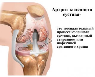 Артрит колена: причины, симптоматика и принципы лечения