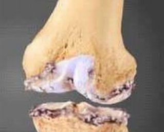 Остеоартроз коленного сустава