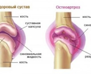 Как лечить остеоартроз колена?
