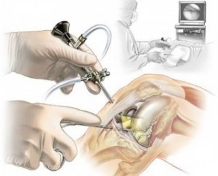 Артроскопия мениска: осложнения и процесс восстановления