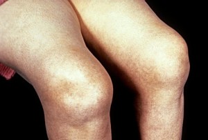 Припухлость и отек колена при артрите