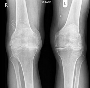 Рентгенограмма пораженного артритом коленного сустава