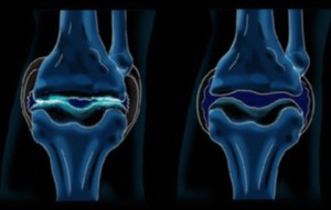 Схема артрита коленного сустава