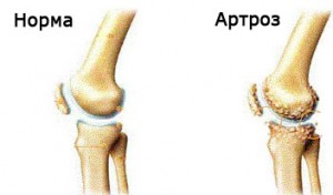 Схема остеоартроза коленного сустава