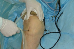Артроскопия коленного сустава