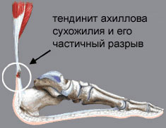 Схема тенденита колена