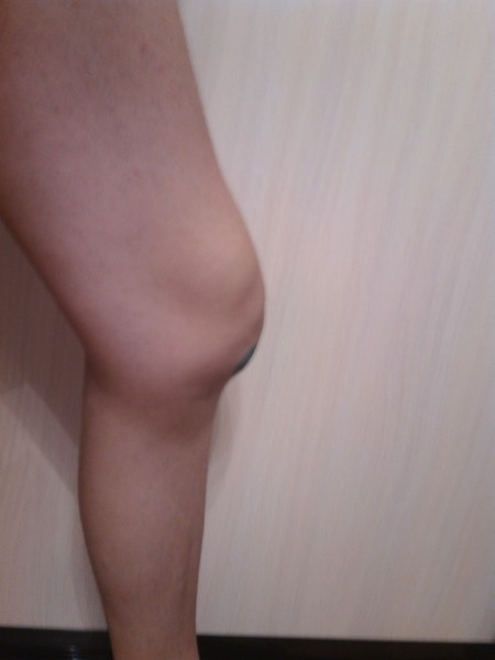 Изображение - Негомогенная патологическая жидкость в коленном суставе zhidkost-v-kolennom-sustave-03