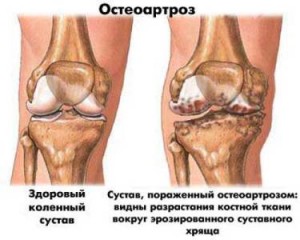 Остеоартроз коленей