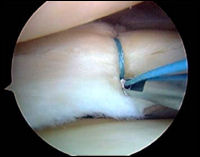 Снимок мениска коленного сустава
