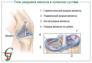 Изображение - Как долго заживает мениск коленного сустава razriv_meniska-300x207
