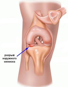 Симптомы разрыва мениска коленного сустава