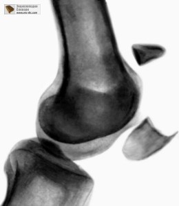 Отломки кости на рентгене колена